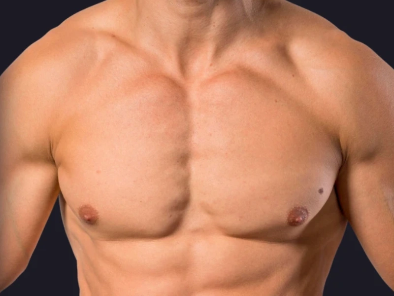 Male breast correction
