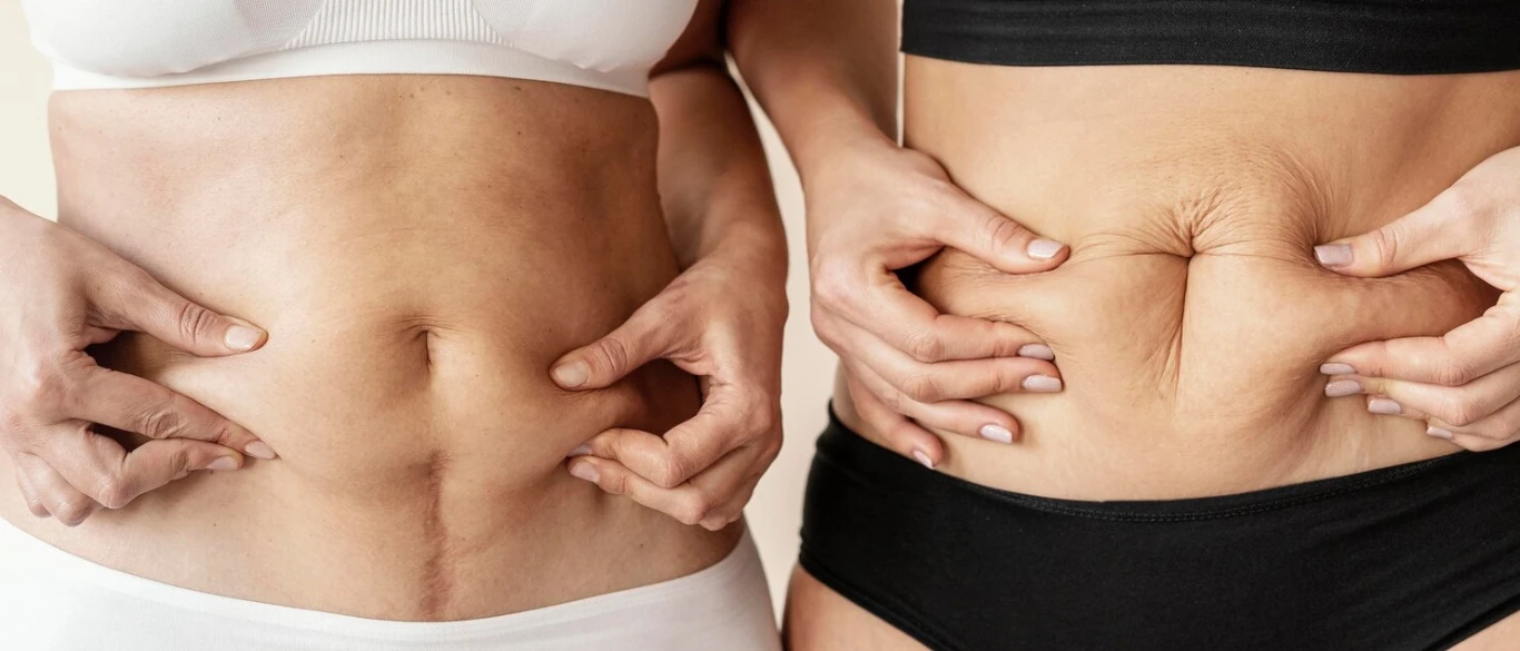 Liposuction vs Tummy Tuck: Which One Is Right for You?