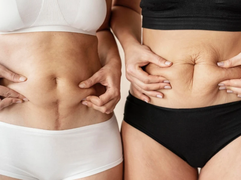 Liposuction vs Tummy Tuck: Which One Is Right for You?