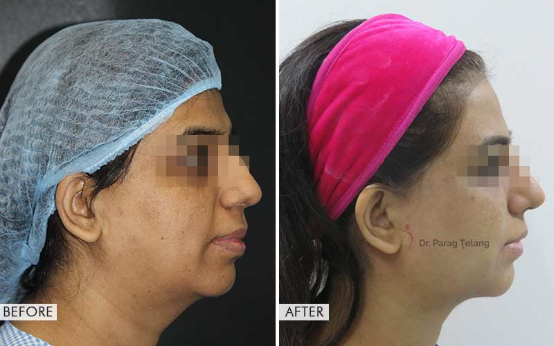 Cheek Implants