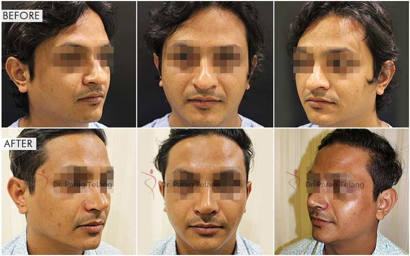 Rhinoplasty Surgery Before and After Results
