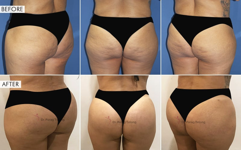 Butt Augmentation Before and After Results