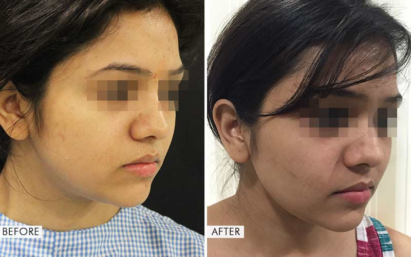 Buccal Fat Pad Removal Surgery Before and After Results