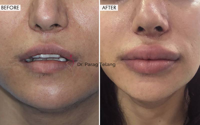 Lip Contouring Surgery Before and After Results