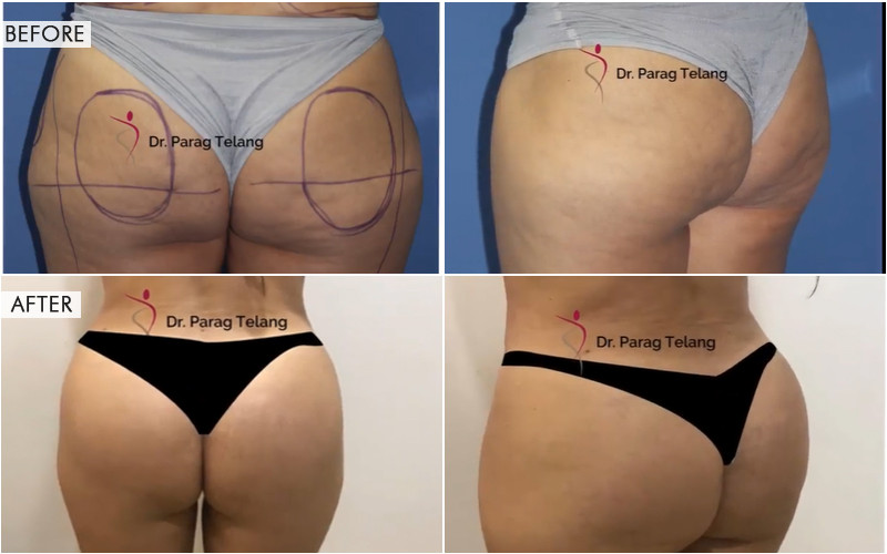 Butt Augmentation Before and After Results