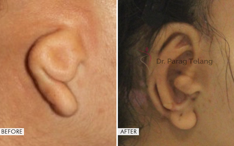 Traumatic Ear Loss Treatment Before and After Results
