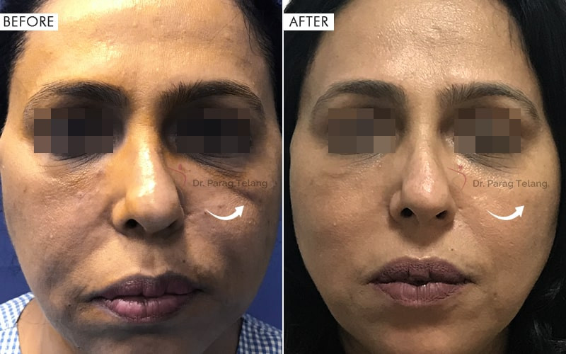 Thread Lift Before and After Results