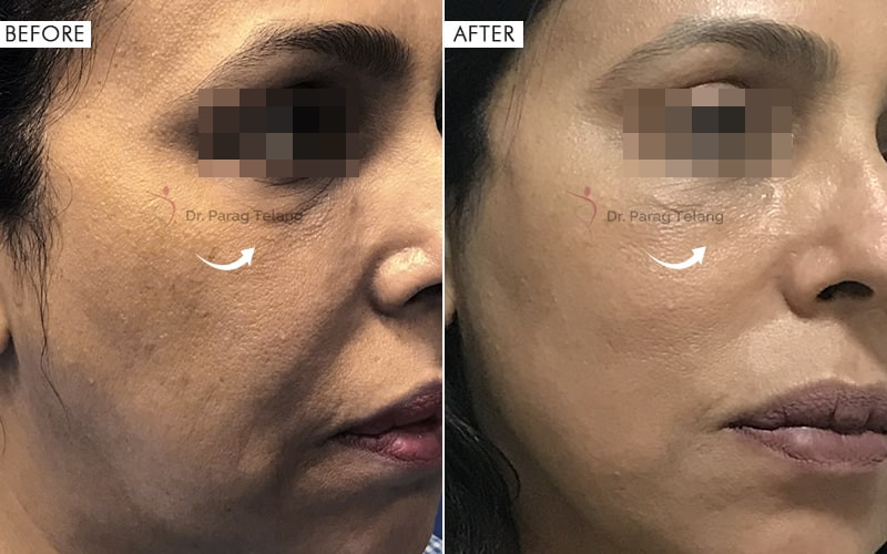 Thread Lift Before and After Results