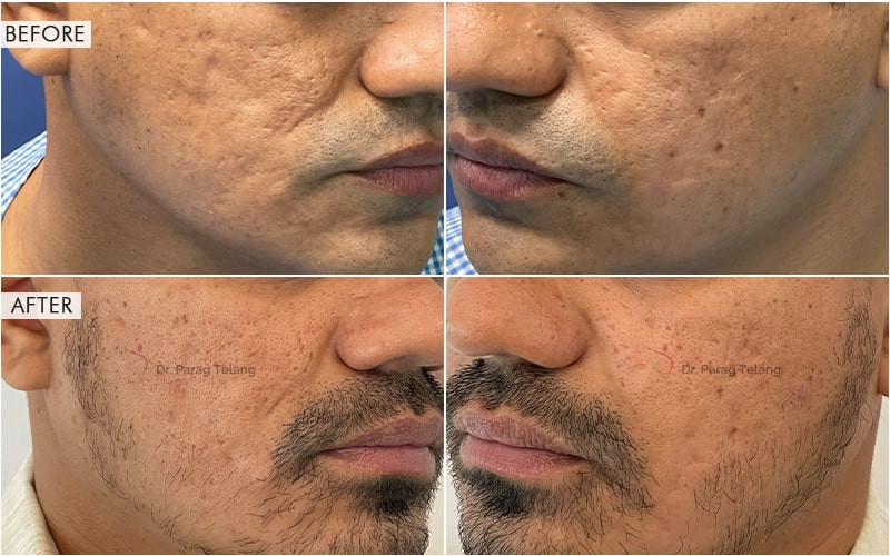 Nano Fat Grafting