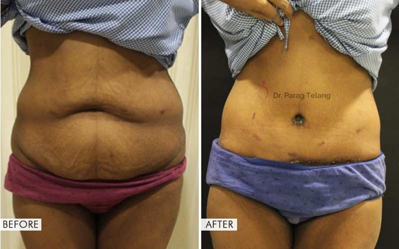 Belt Lipectomy Surgery Before and After Results