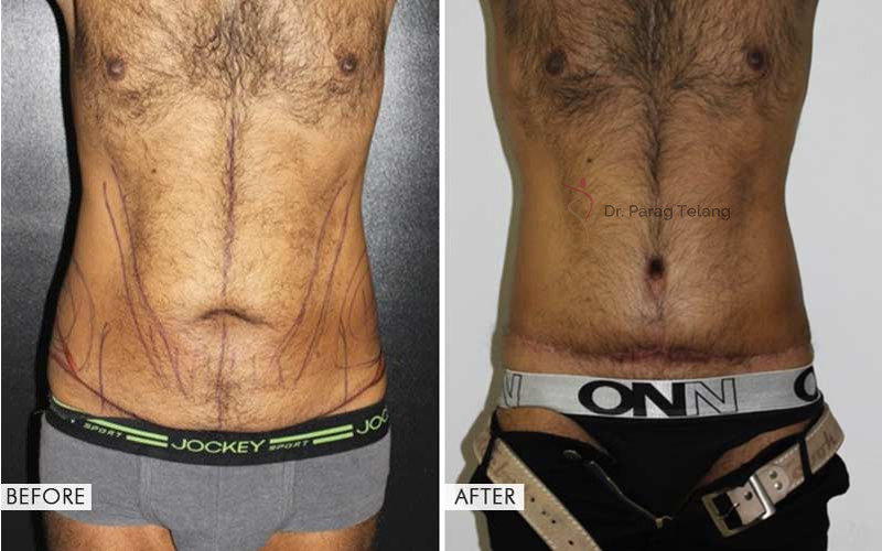 Belt Lipectomy Surgery Before and After Results