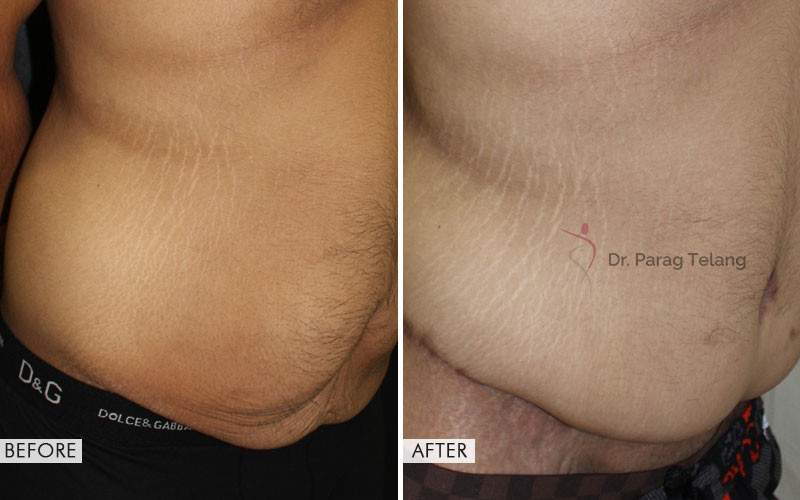 Belt Lipectomy Surgery Before and After Results