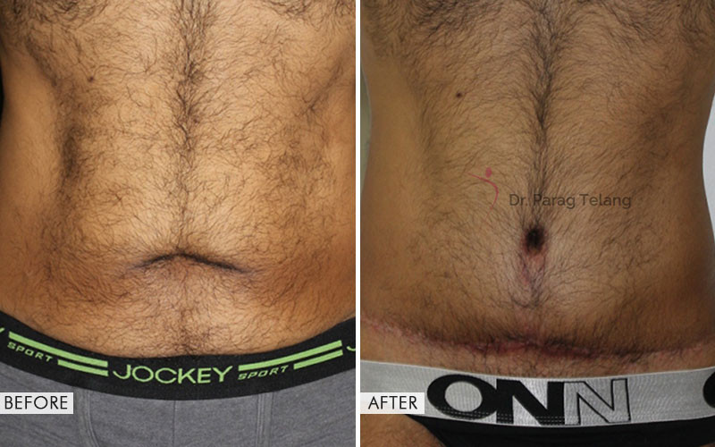Belt Lipectomy Surgery Before and After Results