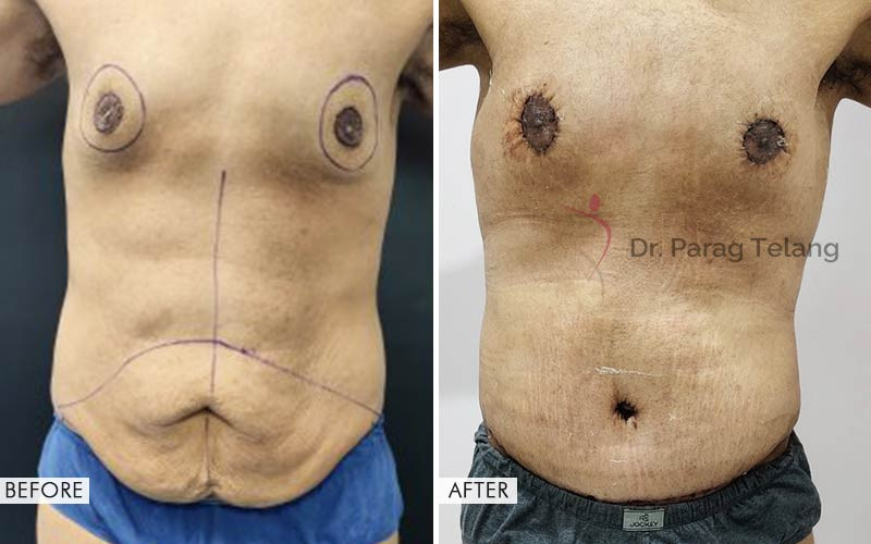 Belt Lipectomy Surgery Before and After Results