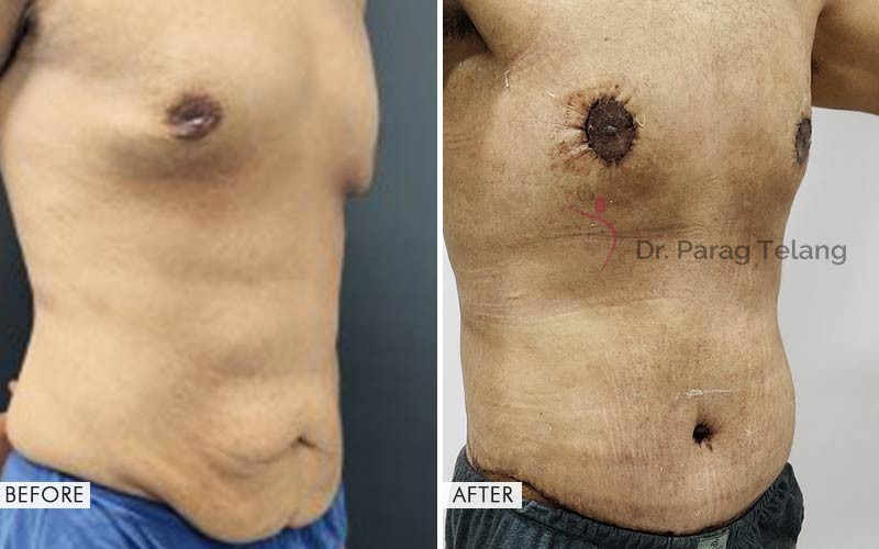 Belt Lipectomy Surgery Before and After Results