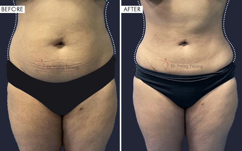 Body Contouring Before and After Results