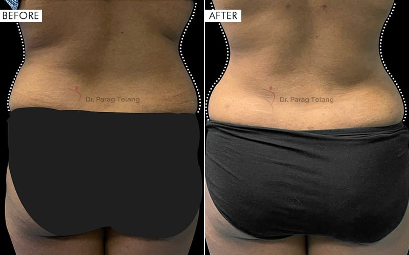 Body Contouring Procedures Before and After Results