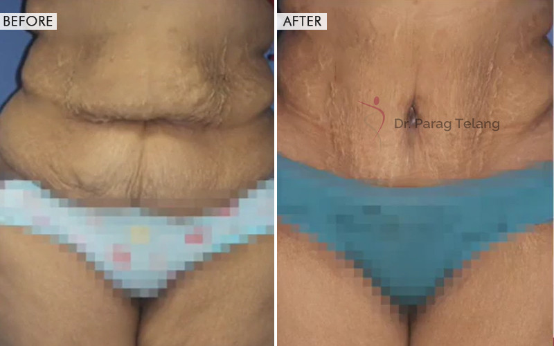Body Contouring Procedures
