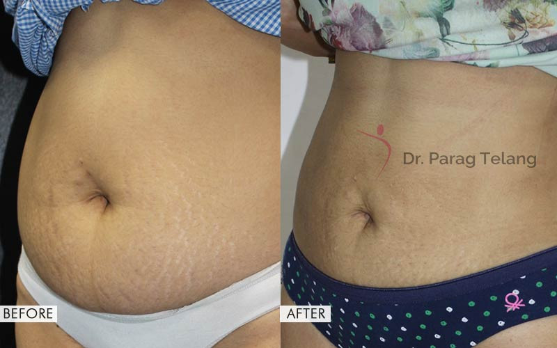 Body Contouring Procedures