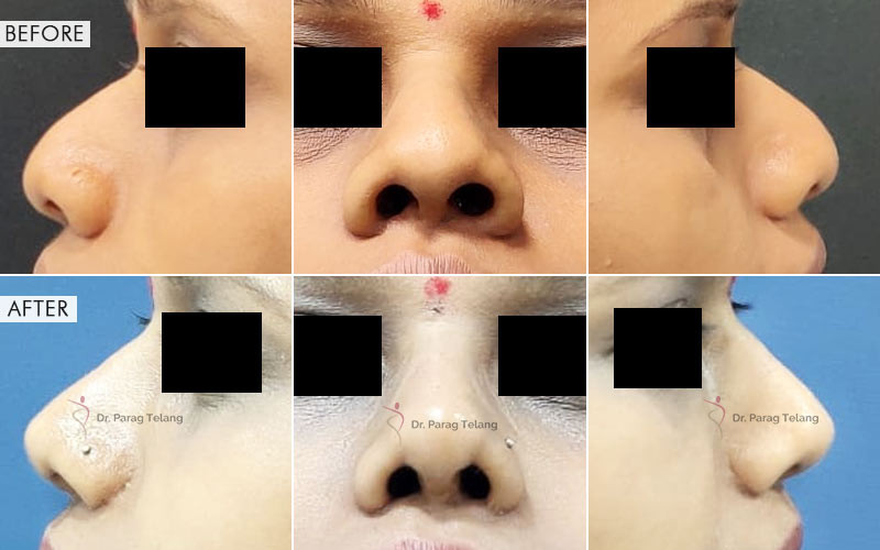 Rhinoplasty Surgery Before and After Results