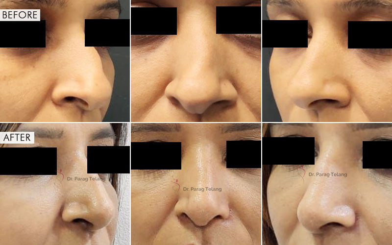 Rhinoplasty