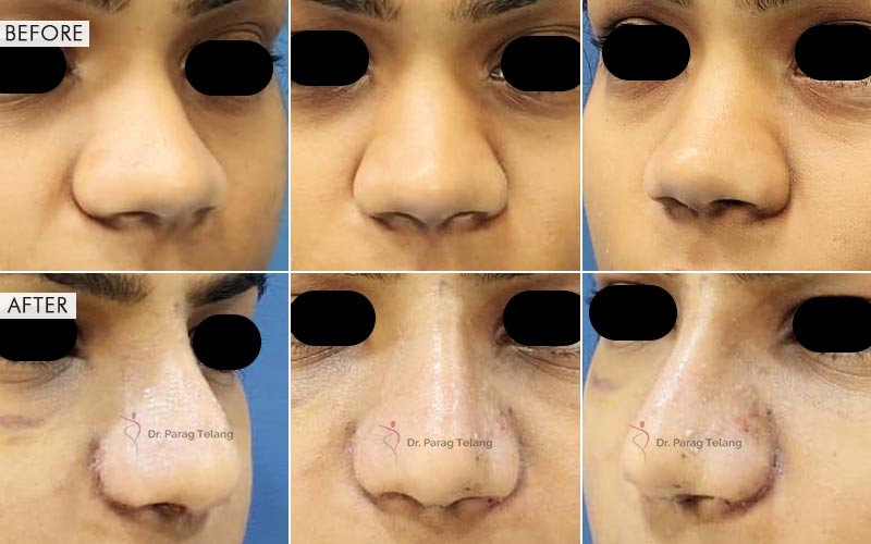 Rhinoplasty