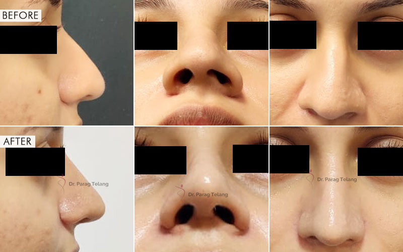 Rhinoplasty
