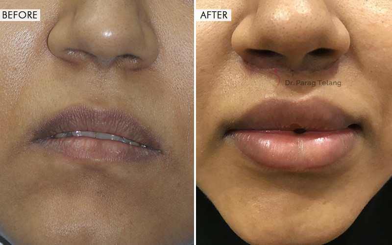 Lip Contouring