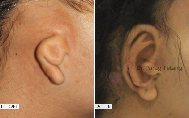 Traumatic Ear Loss