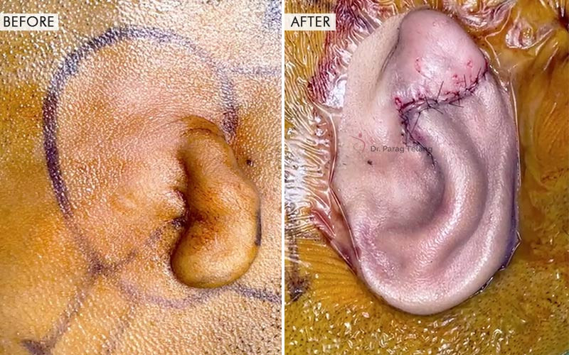Traumatic Ear Loss