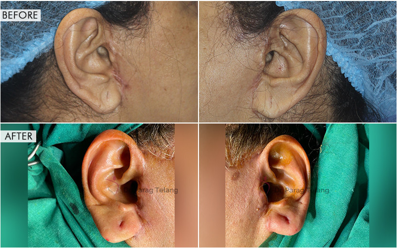 Traumatic Ear Loss