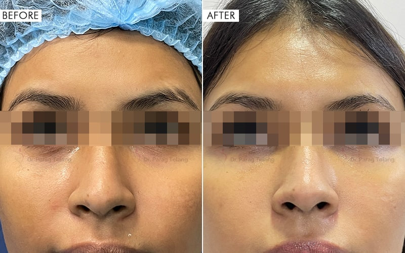Nano Fat Grafting
