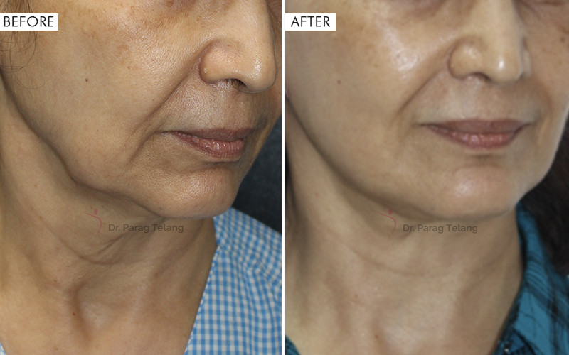 Jaw Contouring