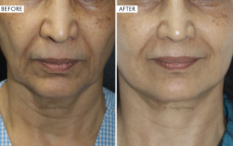 Jaw Contouring