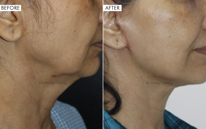 Jaw Contouring