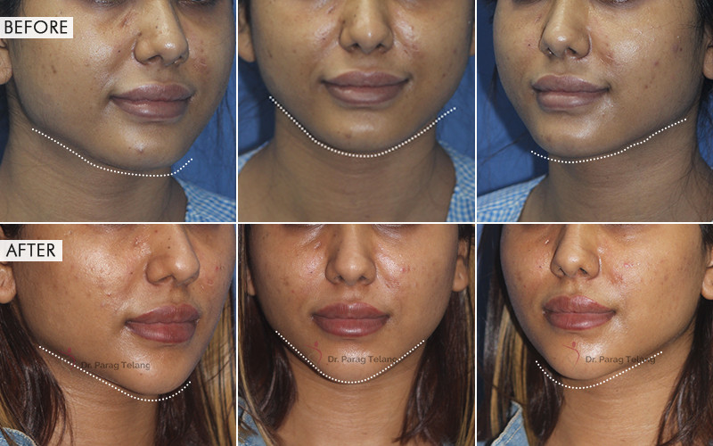 Jaw Contouring