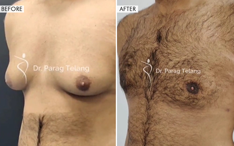 Gynecomastia Surgery Before and After Results