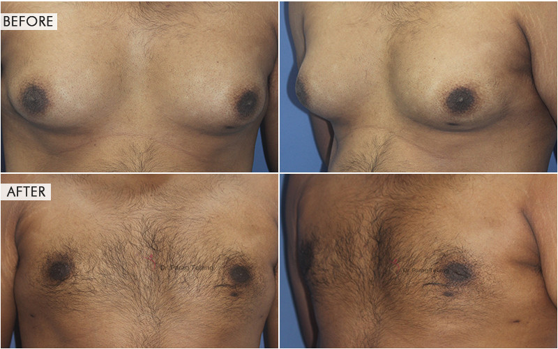 Gynecomastia Surgery Before and After Results