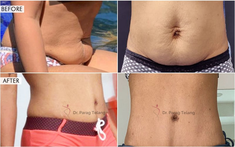 Tummy Tuck Surgery Before and After Results
