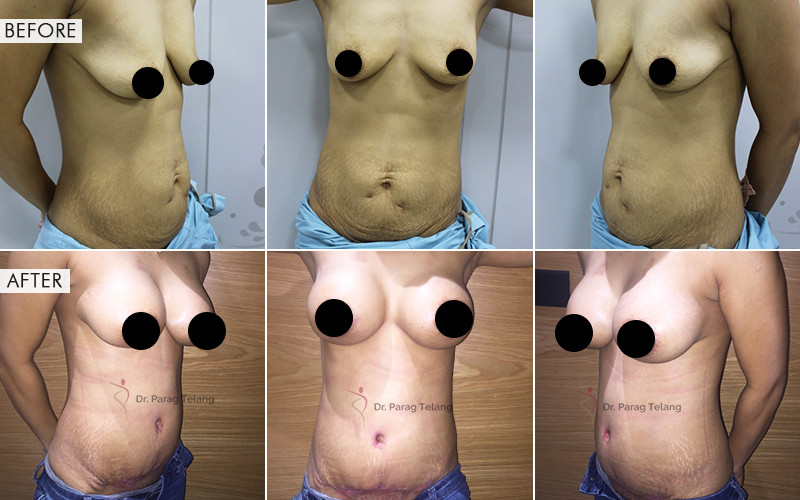 Mommy Makeover surgery Before and After Results