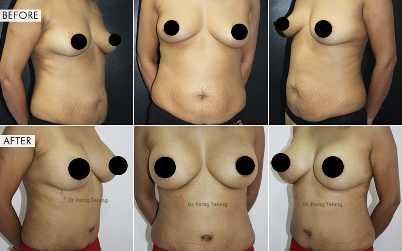 Mommy Makeover surgery Before and After Results