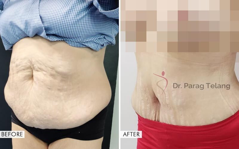 Mommy Makeover surgery Before and After Results