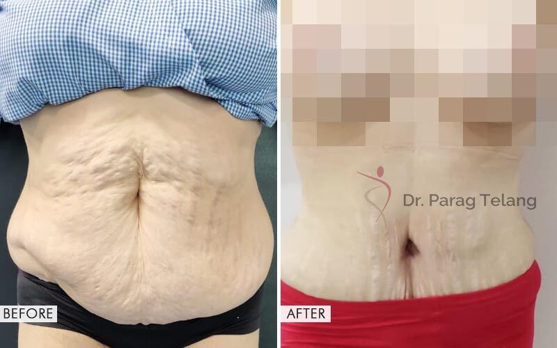 Mommy Makeover surgery Before and After Results