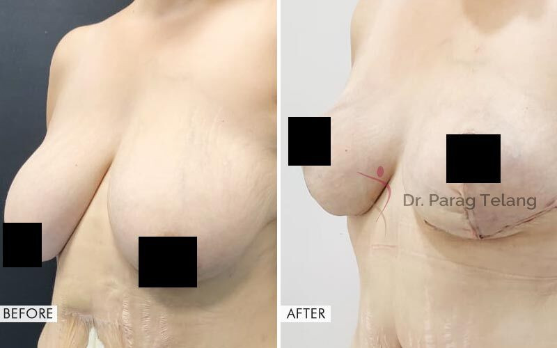 Mommy Makeover surgery Before and After Results