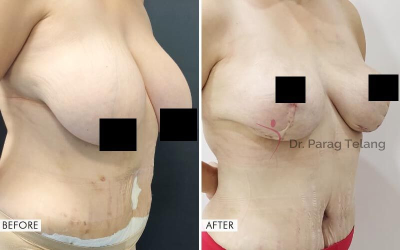 Mommy Makeover surgery Before and After Results