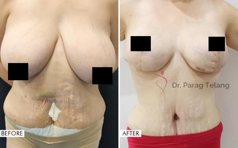 Mommy Makeover surgery Before and After Results