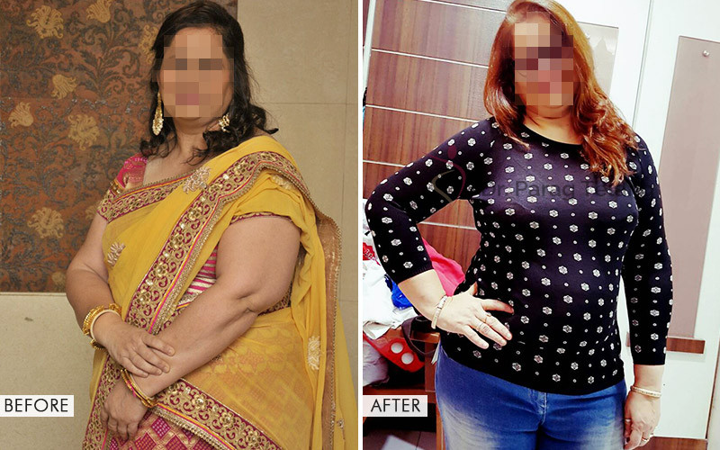 Liposuction surgery Before and After Results