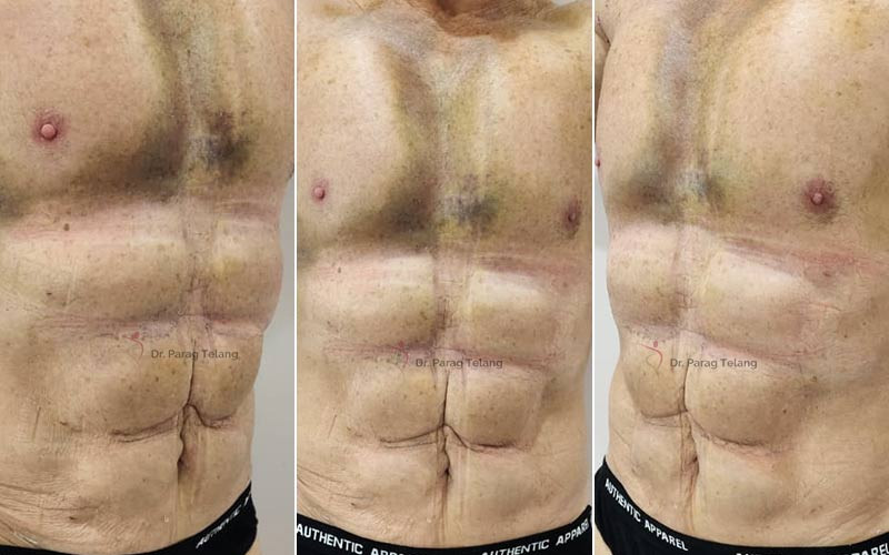 Liposuction surgery Before and After Results