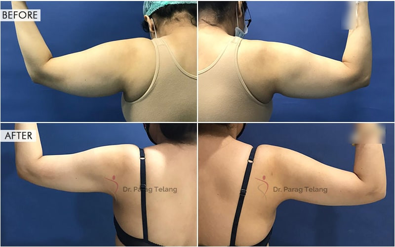 Liposuction surgery Before and After Results