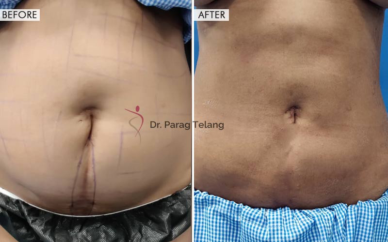 Liposuction surgery Before and After Results